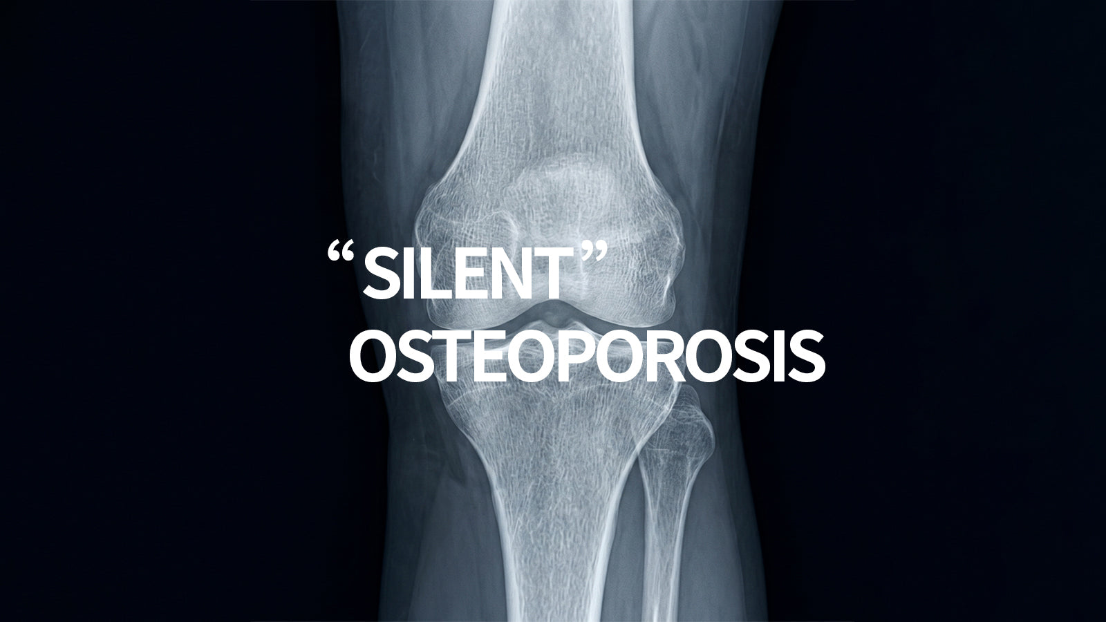 Can Osteoporosis Be Reversed? – A Complete Bone Health Guide From Mulittea supplement